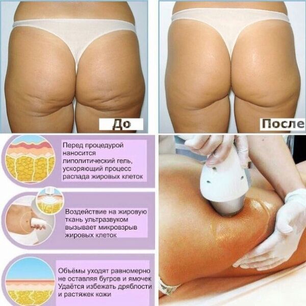 30984 Аппарат 5 в 1 Kim 8 Кавитация, RF для тела и лица, Вакуумный биполярный RF AURO  - Вид №8